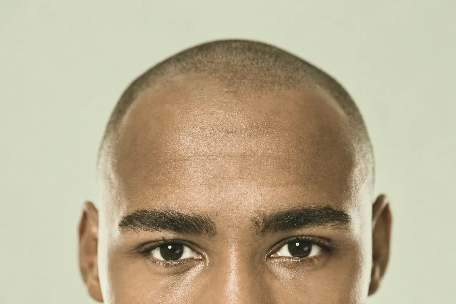 Afro-Textured Hair Transplant