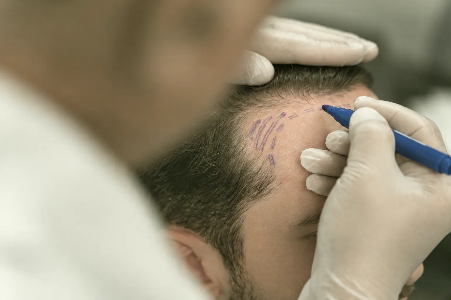 FUT Hair Transplant