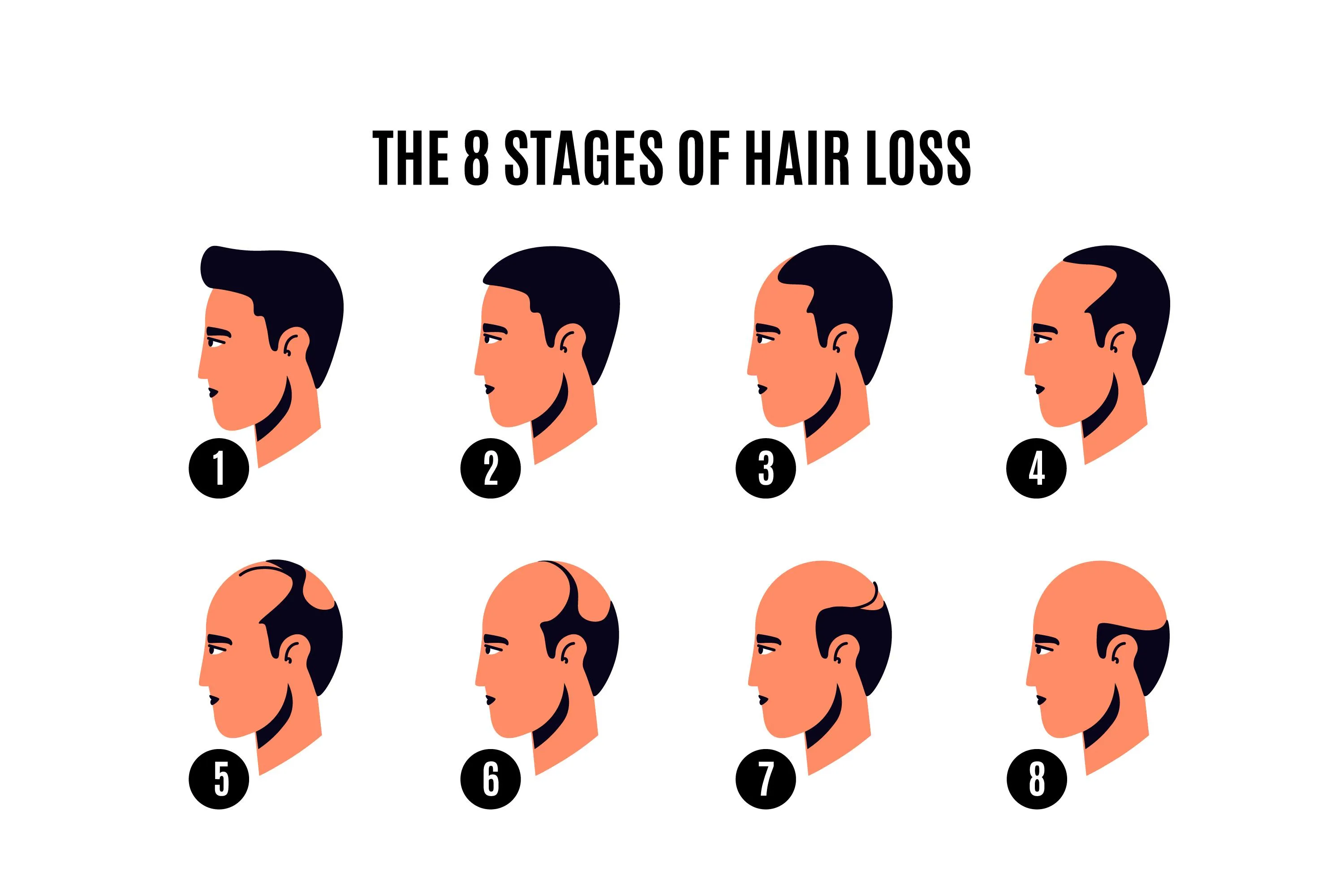 The Norwood Scale, Explained: What Stage Are You Actually At?